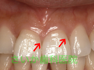 健康な歯ぐき写真2