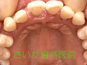 歯周病写真-2