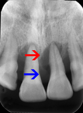 歯周病レントゲン-1